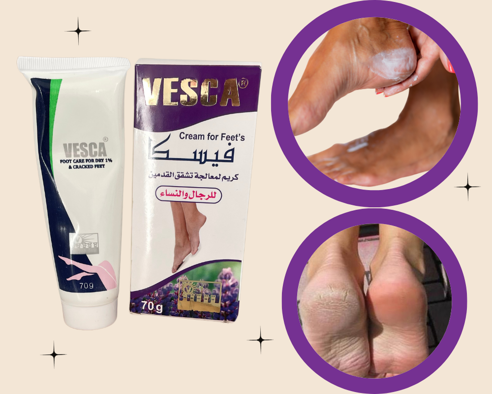 فيسكا لمعالجة تشققات قدمين